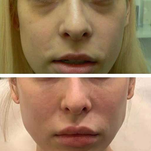 under eye dermal filler midtown manhattan nyc